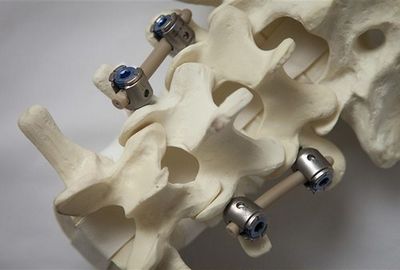 Хирургия на херния в сакралния гръбначен стълб