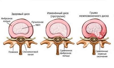 Симптомите на херния на гръбнака на отделение на гръбнака