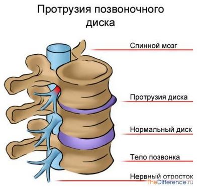 Гърбът на гръбначния диск е херния