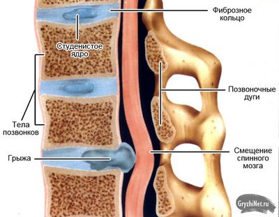 Какво представлява херния диск на гръбначния стълб?