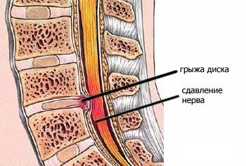 Какво представлява херния диск на гръбначния стълб?