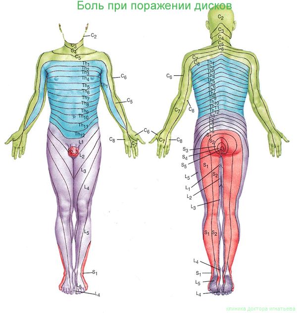 Причини, симптоми и лечение на гръбначни (гръбначни) задни хернии на междупрешленни дискове