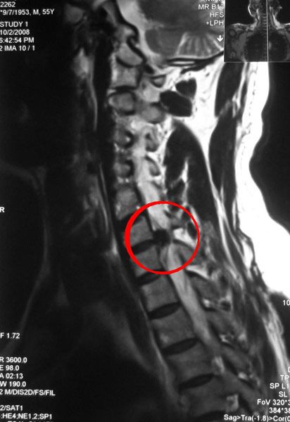 Причини, симптоми и лечение на интервертебралната херния на гръбначния стълб