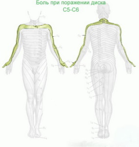 Paramedic (paramedial) дясна и ляво-едностранна херния на c5-c6, 14-l5, l5-s1