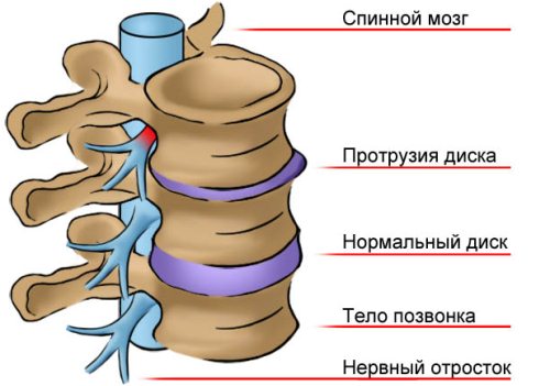 Всичко за изпъкналостта на дисковете на лумбалния гръбнак (13-14, 14-15, 15-s1)