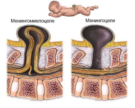 Менингоцеле на лумбалния гръбнак и кръста (s2) - причини и лечение
