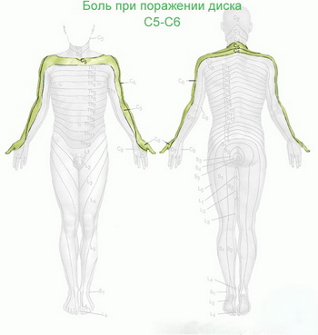 Опасност от изпъкване на цервикалния гръбнак на сегменти c3-c4, c4-c5, c5-c6, c6-c7