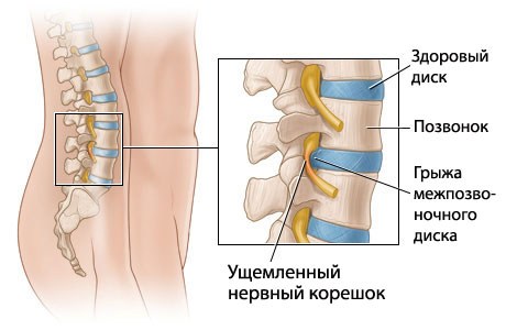 Гръбначна херния на различни части на гръбначния стълб - причини за появата, симптомите и признаците