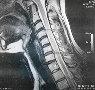 Симптоми, диагноза, лечение на херния в гръбначния стълб