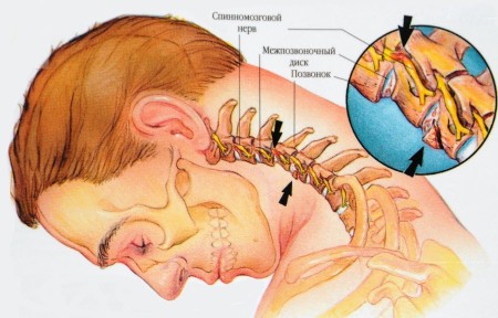 Симптоми, диагноза, лечение на херния в гръбначния стълб