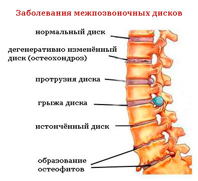 Болки в гърба в долната част на гърба и краката