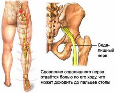 Болката в гърба дава в крака как може да бъде