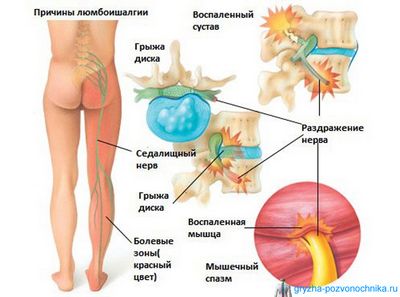 Болки в гърба симптоми и лечение