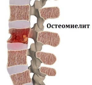 Болка и долна част на гърба и температура 37