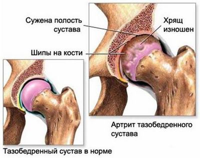 Болка в долната част на гърба и тазобедрените стави