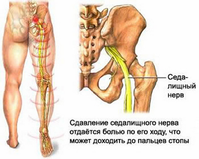 Болка при лечението на долните гърба и краката