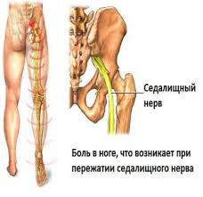 Болката в гърба дава десния крак на седалището