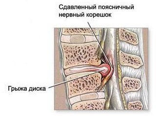 Прикрепеният нерв при болката в долната част на гърба дава
