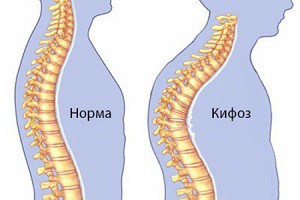 Какво представлява кифозата на гръбначния стълб?