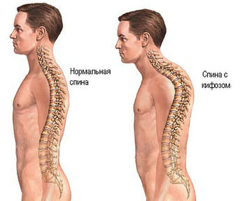 Кифозата на гръдния кош е това, което е