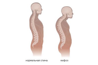 Кифоз на гръбначния стълб е извивката на гръбнака