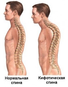 Какво представлява кифозата на гръбнака?