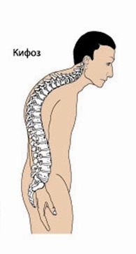 Какво представлява кифозата на гръбнака?