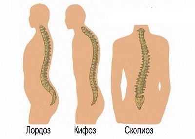 Какво е лордоза и кифоза на гръбначния стълб?