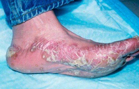 Хиперкератоза на кожата на краката