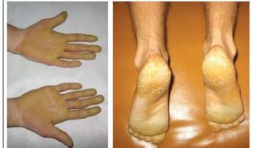 Хиперкератоза на кожата на краката