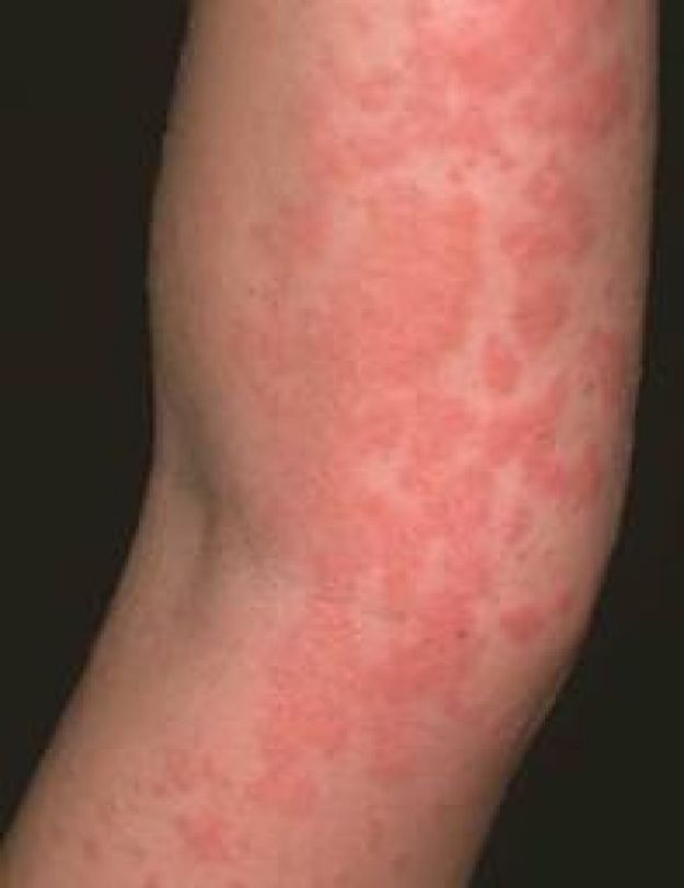 Червени петна по краката - алергии