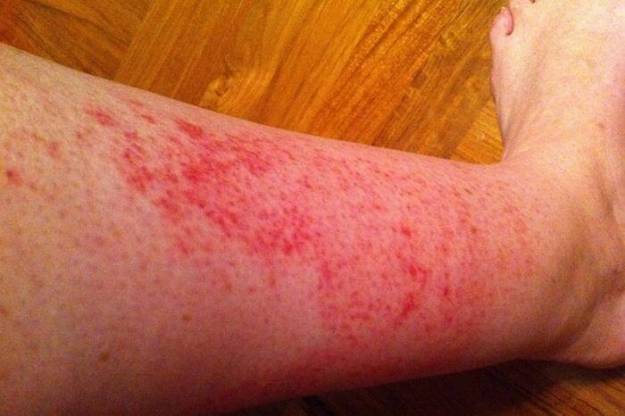 Червени петна по краката - алергии
