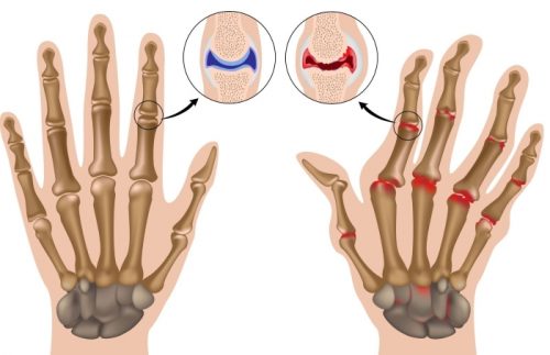 Артрит на ръцете и пръстите: лечение с народни средства
