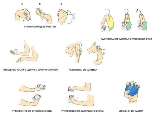 Артрит на ставите на ръката и пръстите: симптоми и лечение