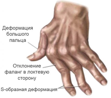 Артрит на ставите на ръката и пръстите: симптоми и лечение