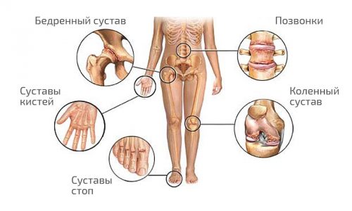 Артрит на коляното при деца: симптоми и лечение