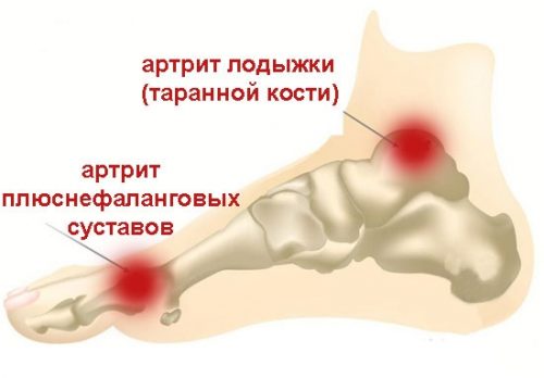 Артрит на малките стави и петата на крака: симптоми и лечение