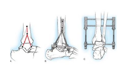 Артродеза на глезена, коляното, гръбначния стълб