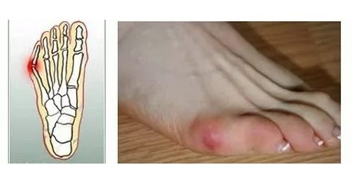 Кокали на крака от страна на крака: причини и лечение