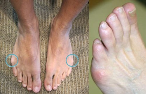 Кокали на крака от страна на крака: причини и лечение