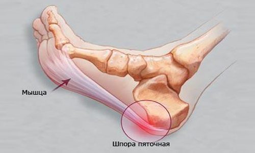 Причини и лечение на костите на крака