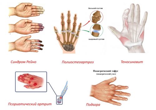 Причини за възпаление на ставите на пръстите и как да ги премахнете