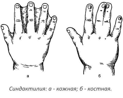 Причини за синдитация (слепени пръсти) и неговото лечение