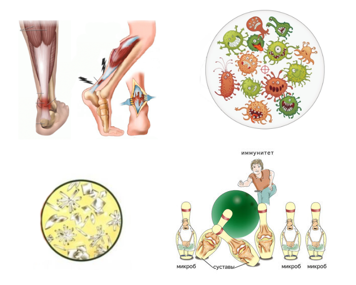 Причини, симптоми и лечение на артрит на глезена