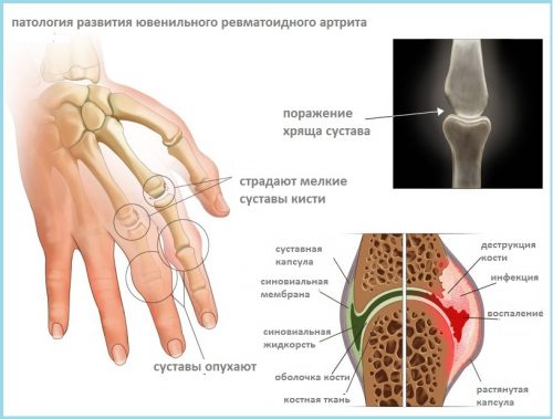 Класификация на артрита