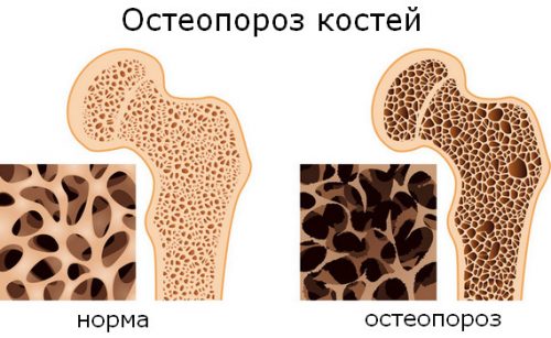 Класификация на остеопорозата