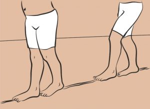 Комплекс от упражнения за крака с деформация на валгус при дете