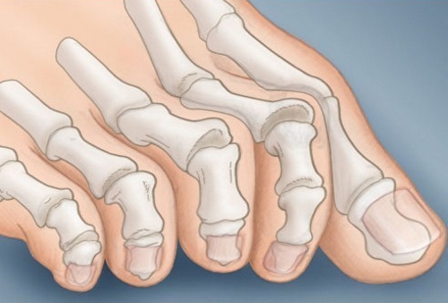 Изкривяване на големи и други пръсти на краката