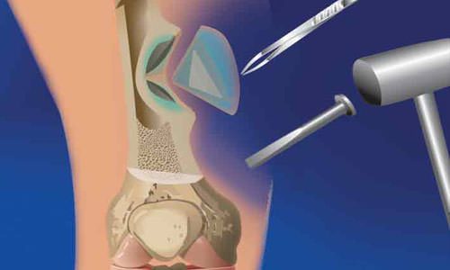 Развитие на остеомиелит след наранявания, фрактури и операции