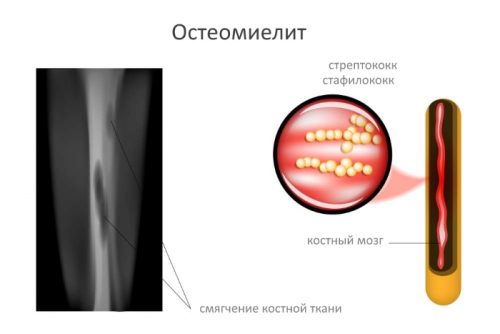 Развитие на остеомиелит след наранявания, фрактури и операции